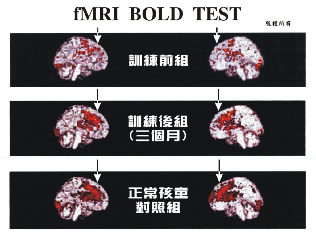 fMRI科學實證：感覺運動訓練如何改變ADHD孩子的大腦——臺北榮總腦造影研究